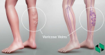 Varicose veins - Why are obesity and high-heeled shoes harmful to veins?