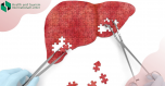Why does acute liver failure develop?