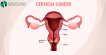 What are the symptoms of cervical cancer?