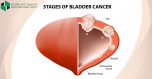 What are the symptoms of Bladder Cancer?