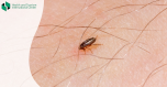 Flea bite