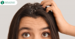 Diagnosis and Treatment of Scalp Fungal Infection