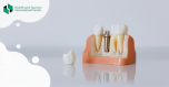 Infection around a dental implant