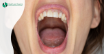Itchy palate