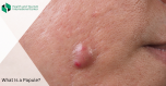 Papule (nodule)