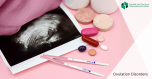ოვულაციის დარღვევა
