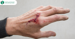 If you notice these symptoms in the wound, the infection has invaded the scratch