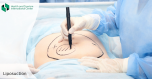 Liposuction - fat removal by surgical method