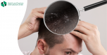 Scalp Fungal Infection