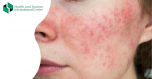 Red cheeks - rosacea