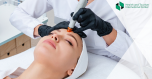 Dermabrasion