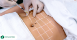 Cryolipolysis - Fat Freezing