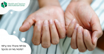 Why do white spots appear on nails?