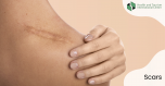 Scars - why not burn a rash?