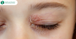 Eyelid Dermatitis Prevention Methods