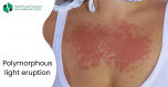Are you bothered by a rash due to being in the sun?