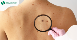 Melanoma - Why you should monitor your moles?