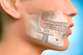 Jaw-face surgery