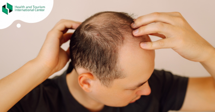 Androgenic Alopecia - Hair Loss in Men