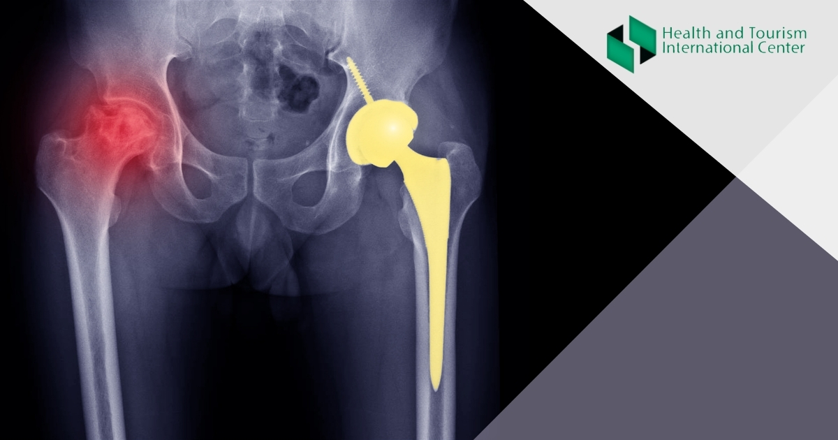 When bone tissue dies - What are the symptoms of avascular necrosis?