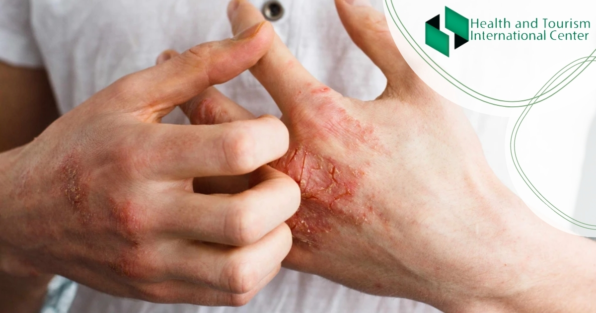 Inflammation of the skin - is dermatitis contagious?