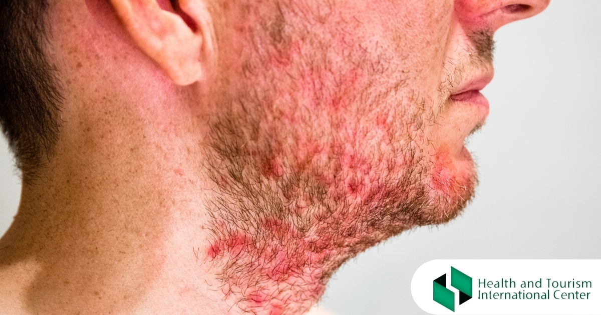 Inflammation of hair follicles - What are the symptoms of folliculitis?