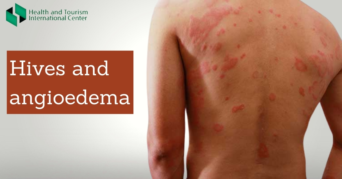 Urticaria - What Causes a Skin Reaction?