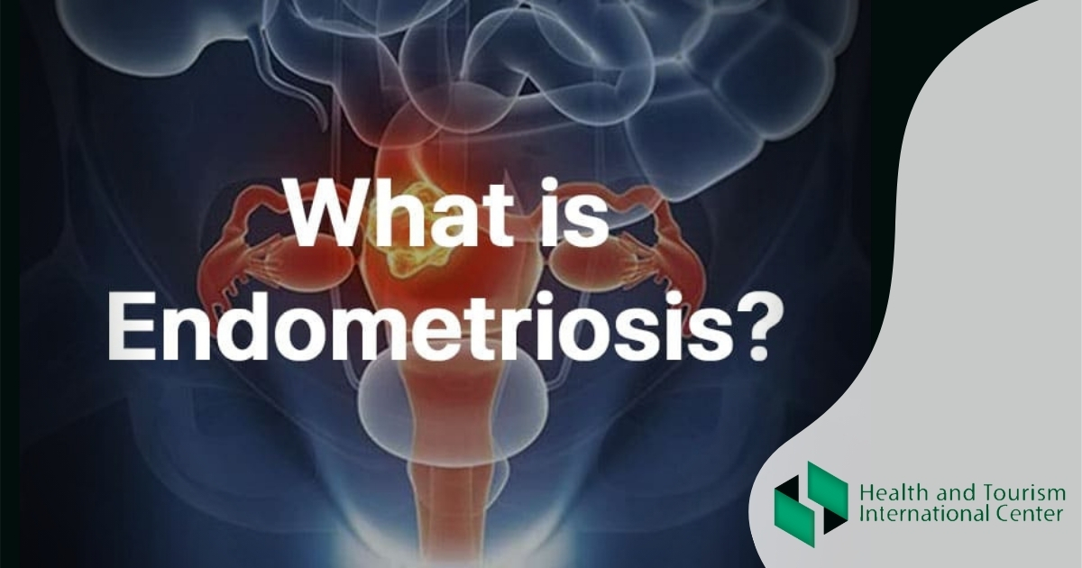 What is endometriosis?