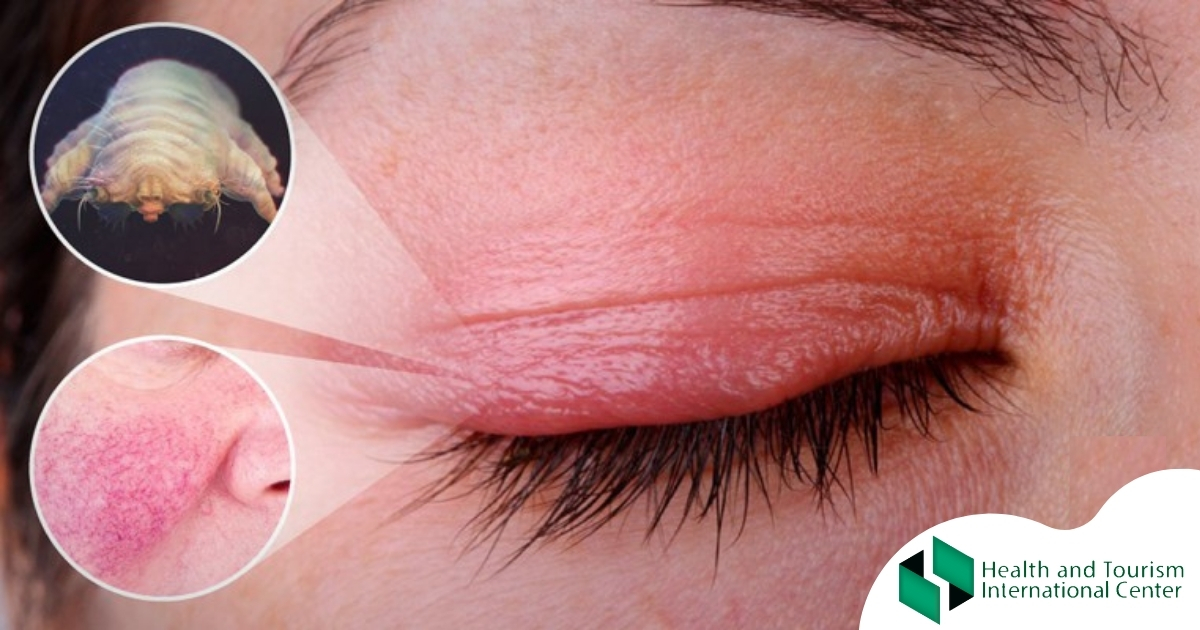 Blepharitis Whatare The Symptoms Of Inflammation Of The Eyelids 