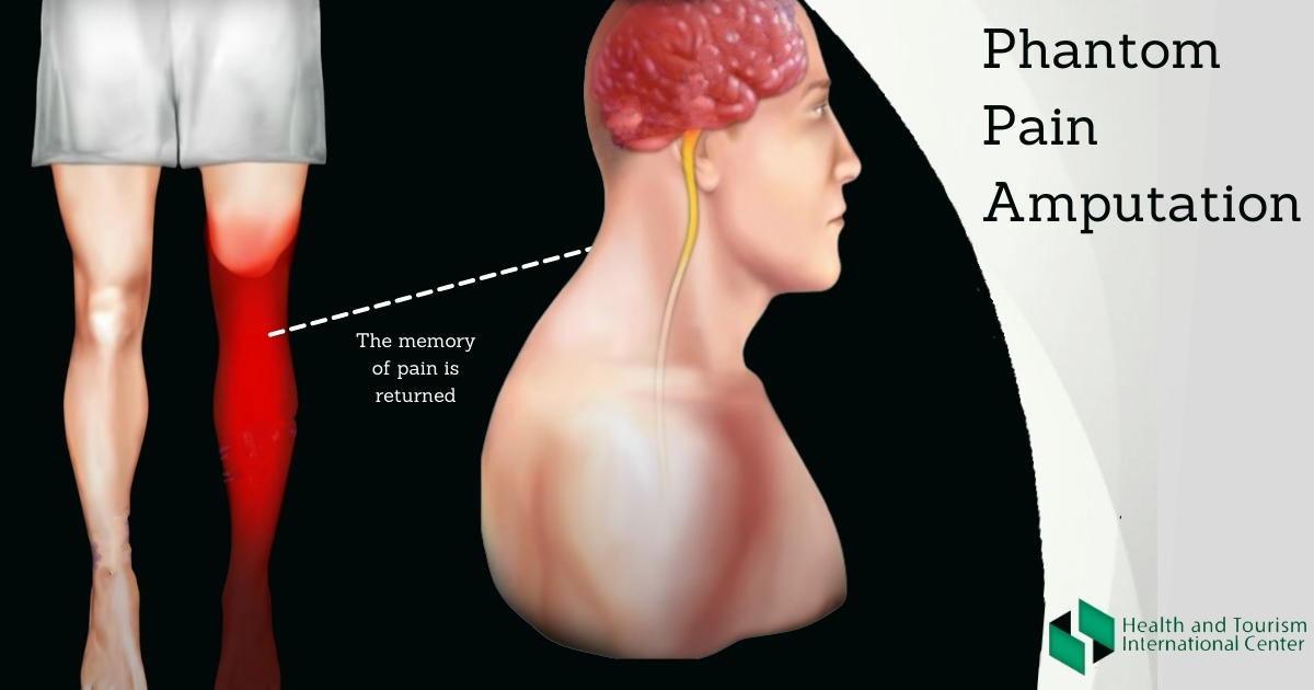 phantom-pain-pain-that-feels-like-it-s-coming-from-a-bodypart-that-s