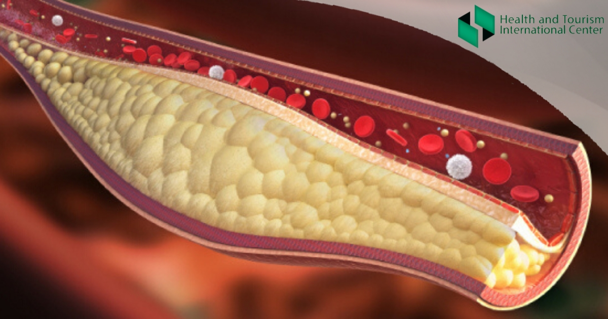 What are the symptoms of high cholesterol?