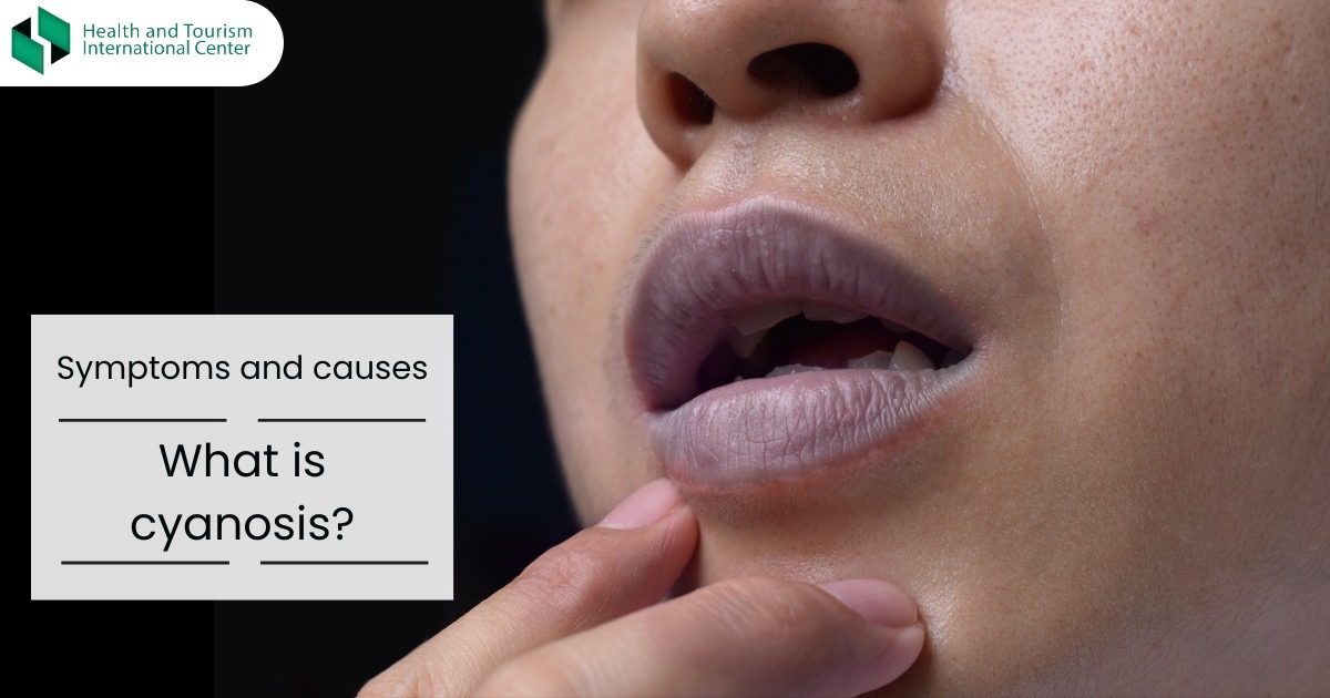 Cyanosis Treatment - When the Skin, Nails, or Lips Turn Blue