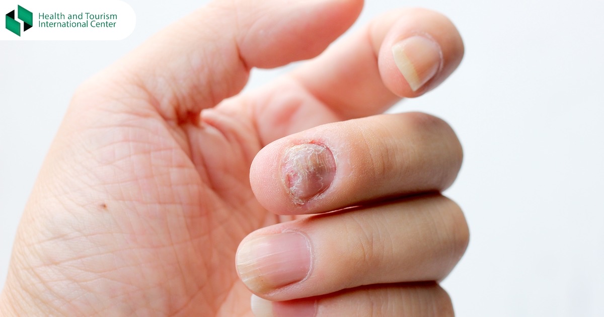 როგორ ავირიდოთ თავიდან ფრჩხილის ინფექცია?