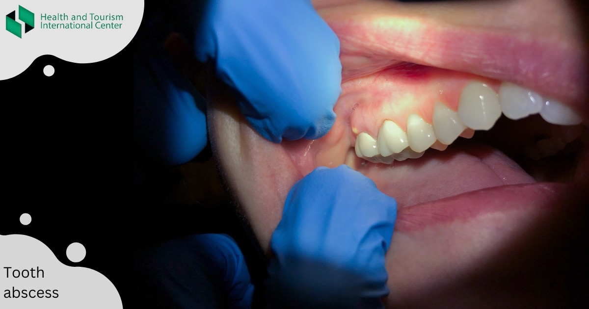 როგორ მკურნალობენ კბილის აბსცესს   