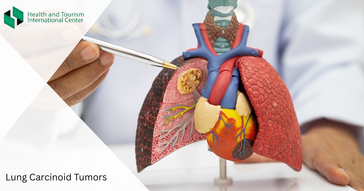 Lung Carcinoid Tumor