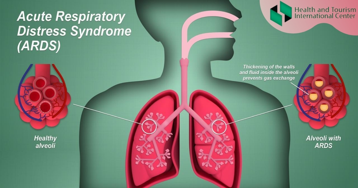 Acute respiratory distress syndrome (ARDS) - Why fluid builds up in alveoli?