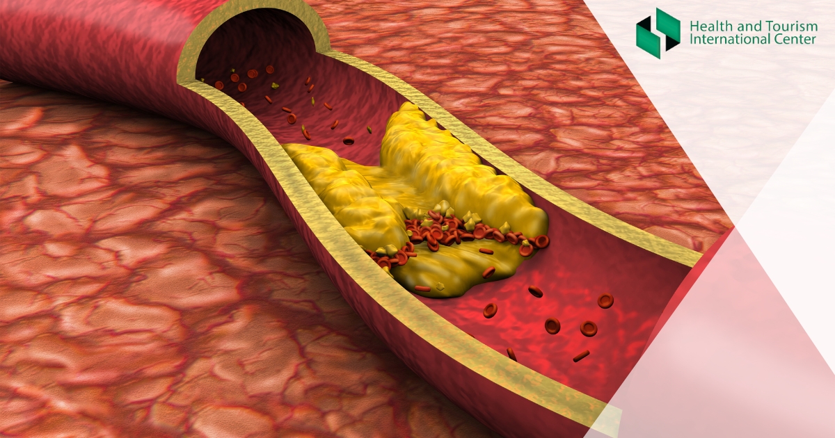 Which product cleans arteries from plaque?