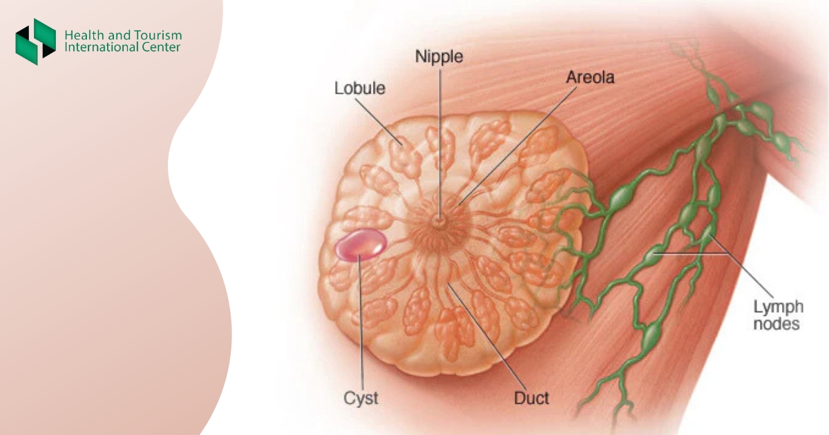 Breast Cyst