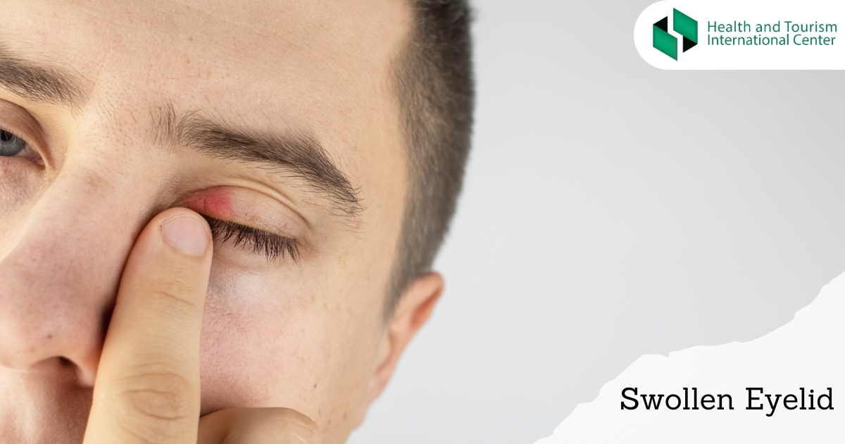 Swollen eyelid - treatment methods - HTI CENTERS | Medical Tourism Center