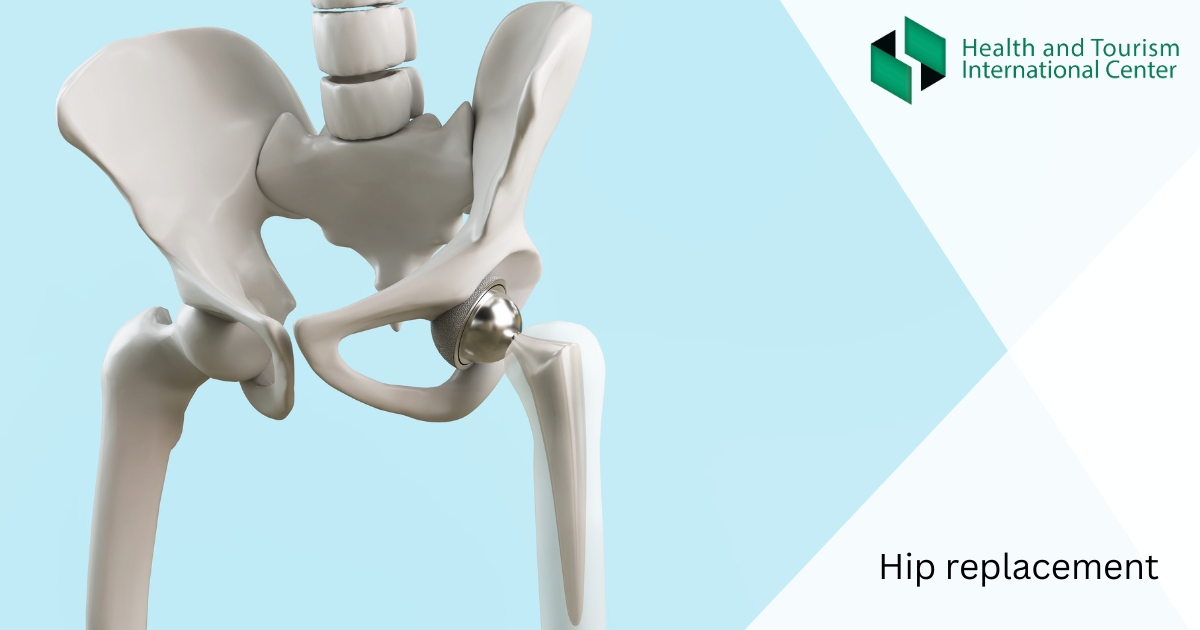 ბარძაყის ჩანაცვლება