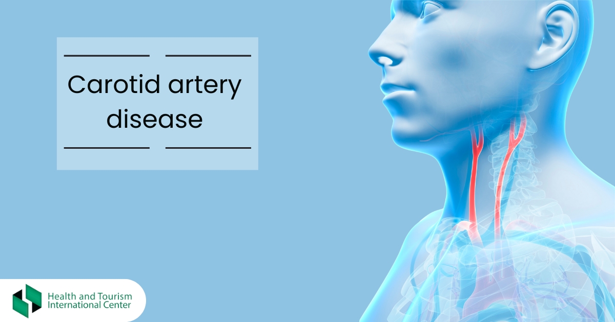 Carotid artery disease