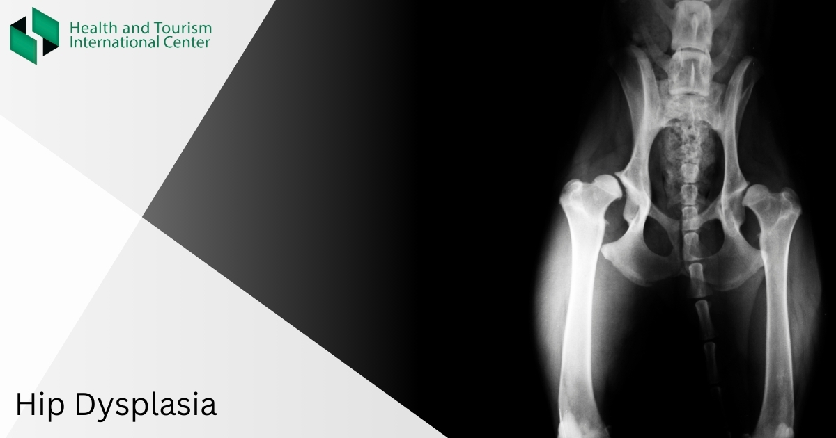 Hip Dysplasia
