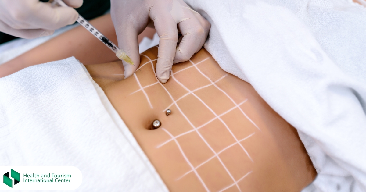 კრიოლიპოლიზი - ცხიმის დაშლა მოყინვით