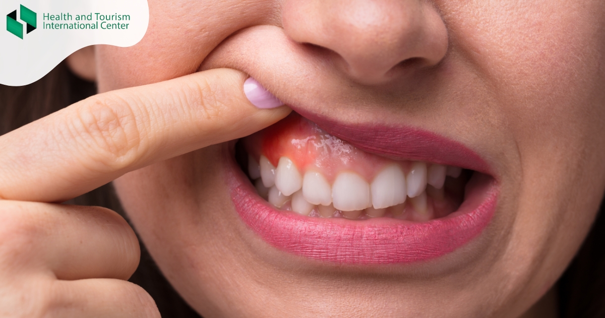 შეშუპებული ღრძილები