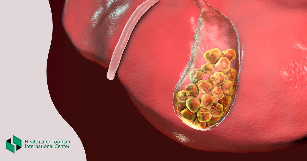 Gallstones